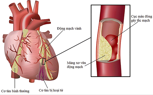 Mảng xơ vữa bít tắc, ngăn dòng máu chảy khiến cơ tim bị hoại tử gây thiếu máu cơ tim